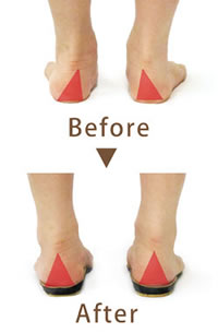 足の歪みを整える(画像)